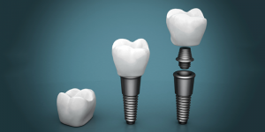 'dental implant'